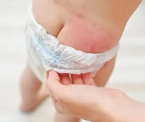 Baby’s Diaper Rash